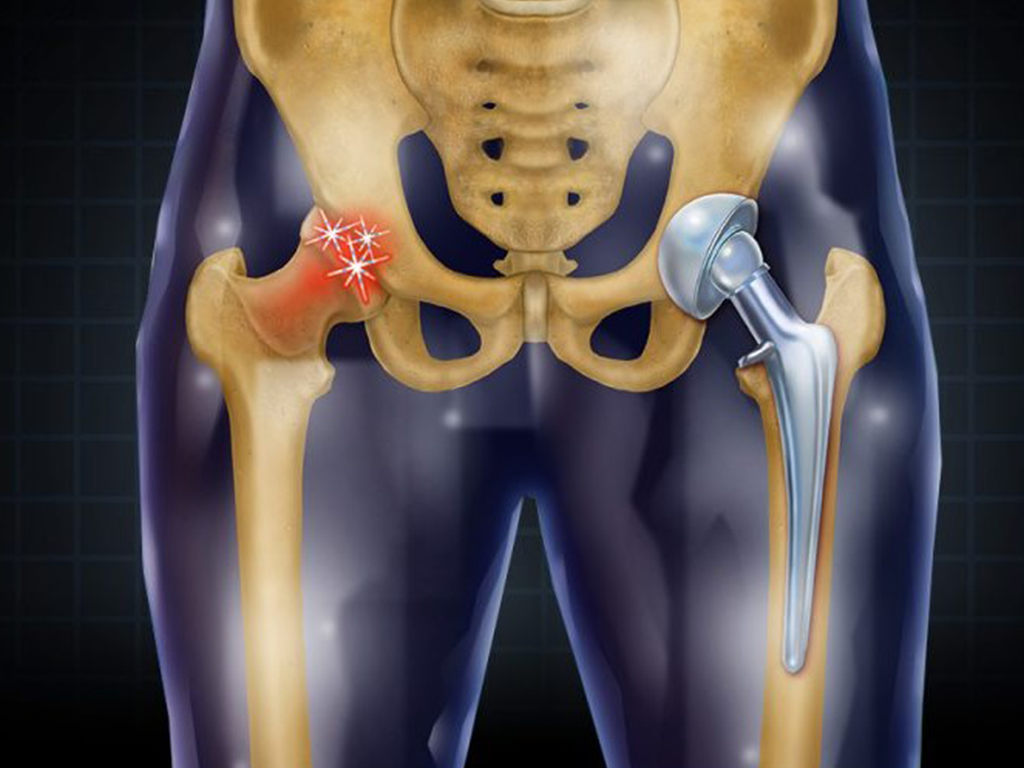 What to expect from a hip replacement surgery? - Sancheti Hospital