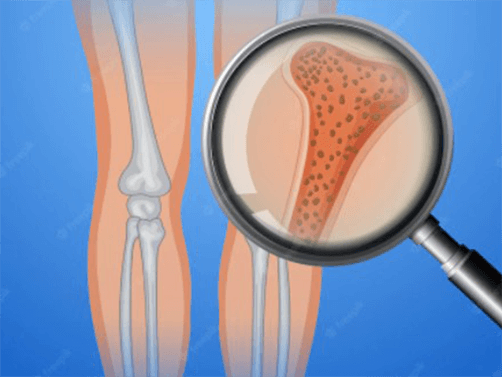The relationship between osteoporosis and bone fractures