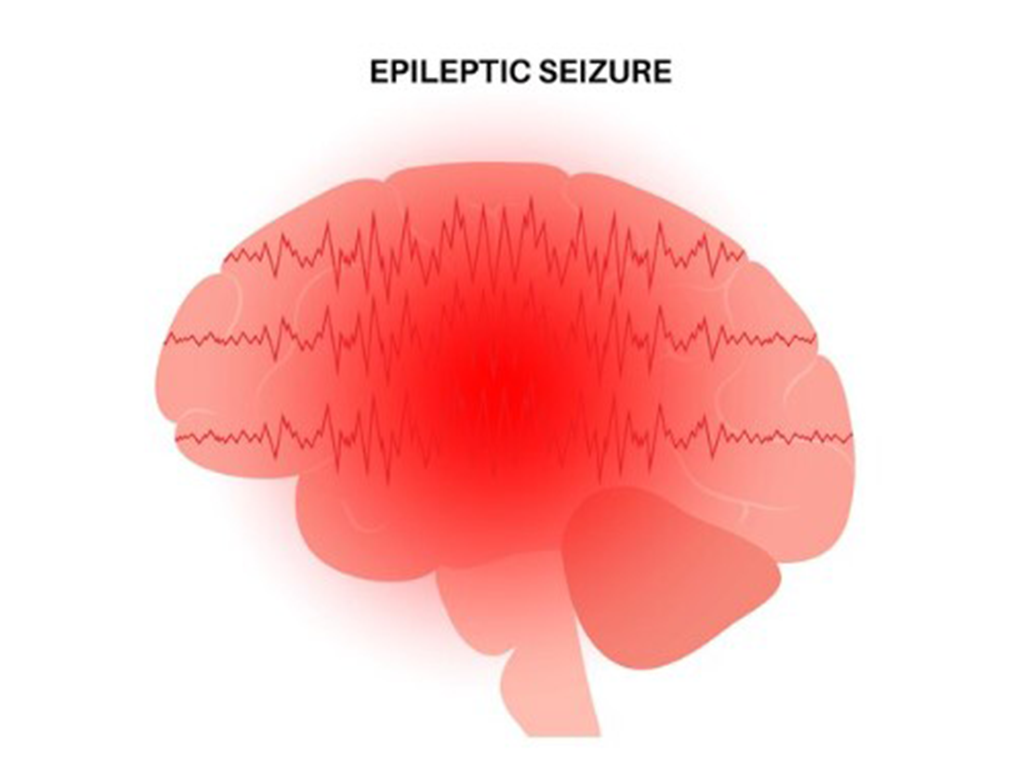 What to Do If Someone Is Having a Seizure