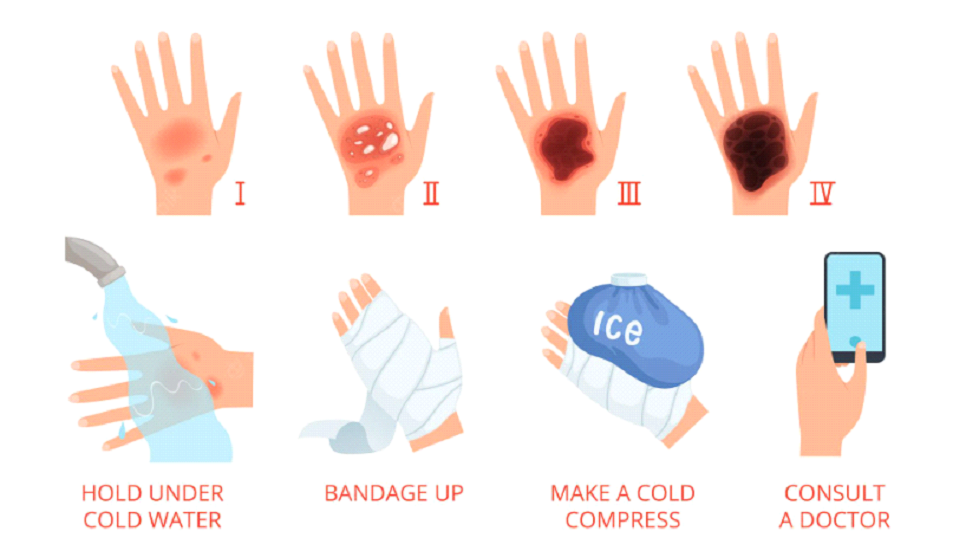 injuries by burns and wounds