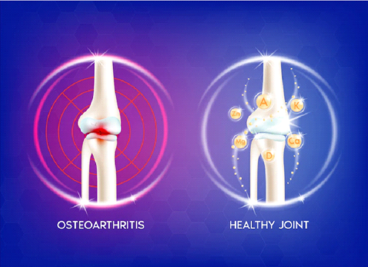 Prevention Of Osteoporosis