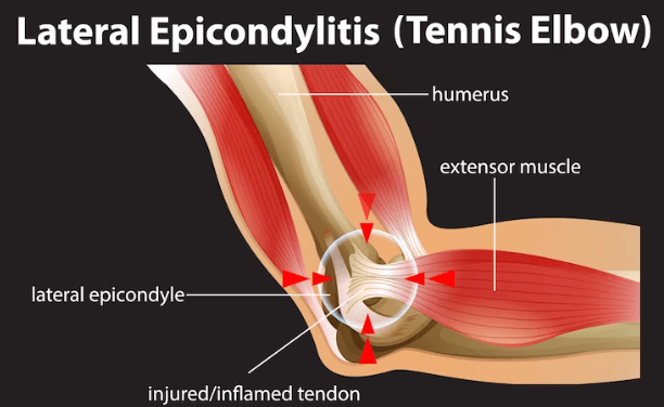 Fordeling Barmhjertige halstørklæde Tennis elbow: What to expect? - Sancheti Hospital