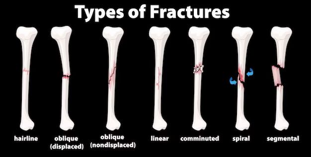 Osteoporosis Bone Fractures
