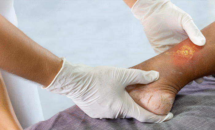 Specialties 1 Aneurysmal Bone Cyst Benign vascular lesion causing bone expansion and destruction treated with curettage bone grafting or sclerotherapy