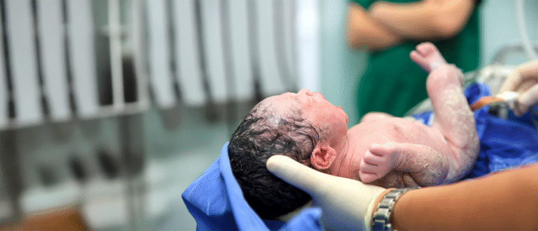 Arthrogryposis Joint contractures present at birth