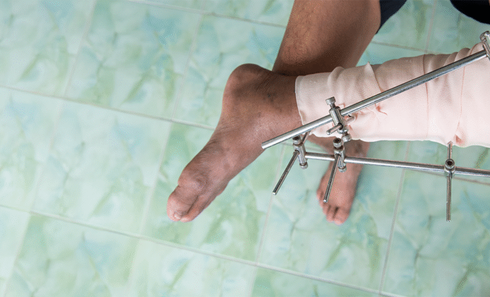 Specialties 2 Comminuted Fractures Bone shatters into multiple fragments often requiring complex surgical reconstruction with plates screws or rods