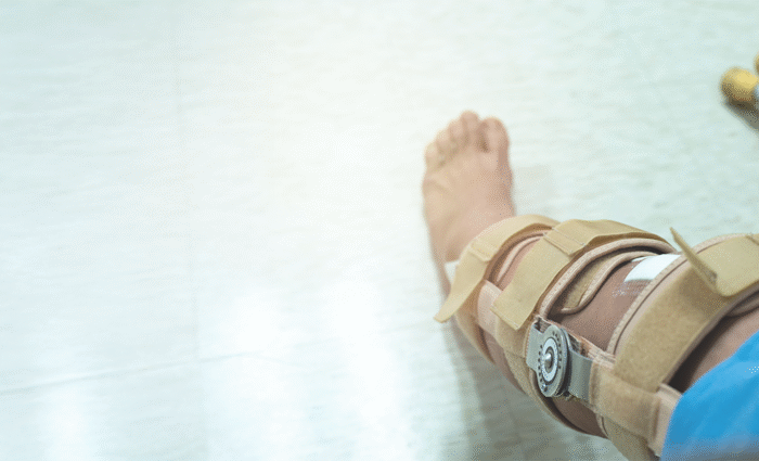 Specialties 4 Crush Injuries Tissue damage from compression force potentially causing compartment syndrome and requiring immediate treatment