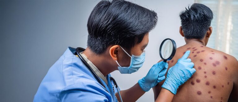 DermatofibrosarcomaProtuberans Low gradesofttissuesarcomawithhighlocalrecurrenceraterequiringwidesurgicalexcisionwithclearmargin