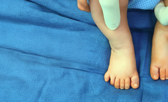 Specialties 3 Polydactyly Extra fingers or toes