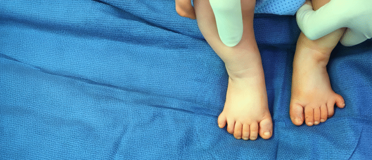 Polydactyly Extra fingers or toes