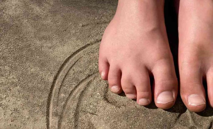 Specialties 2 SyndactylyFusionoffingersortoe