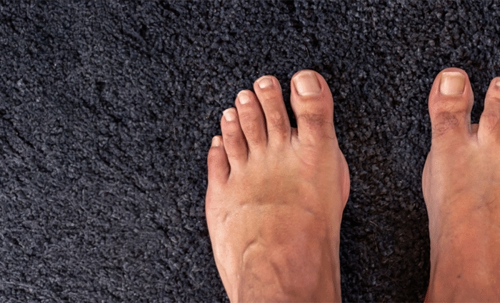 Specialties 3 Bunions Hallux Valgus Bony bump at the base of the big toe