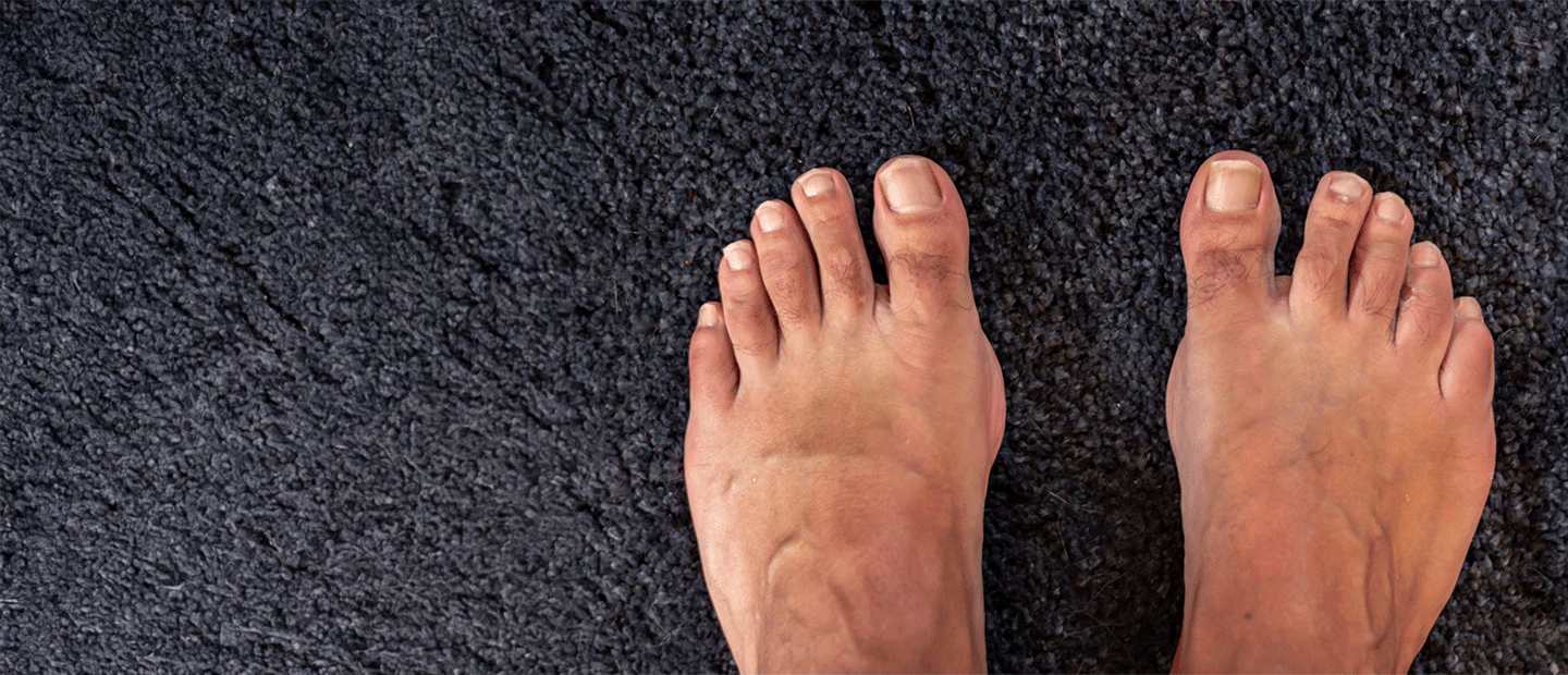 Bunions Treatment, Specialist Care & Hallux Valgus Surgery in Pune