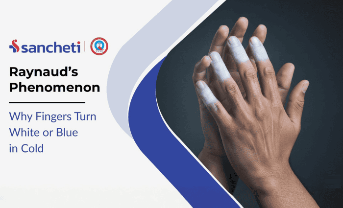 Raynaud's Phenomenon