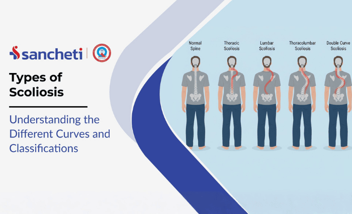 Types of Scoliosis: Understanding the Different Curves and Classifications 1 Types of scoliosis