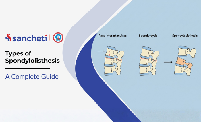 Types of Spondylolisthesis