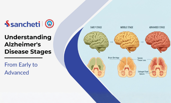 Understanding Alzheimer’s Disease Stages: From Early to Advanced 9 Understanding Alzheimer disease stages