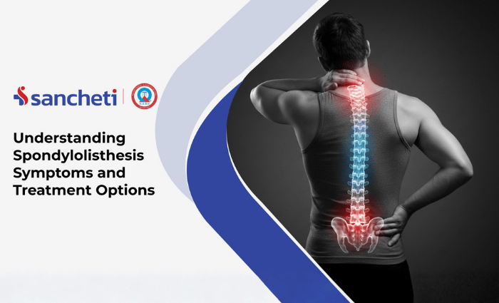 Understanding Spondylolisthesis: Symptoms and Treatment Options 6 Spondylolisthesis symtoms and treatment