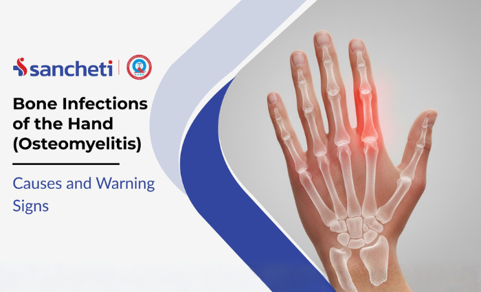 Bone Infections of the Hand (Osteomyelitis): Causes and Warning Signs 5 Bone Infections of the Hand (Osteomyelitis) Causes and Warning Signs