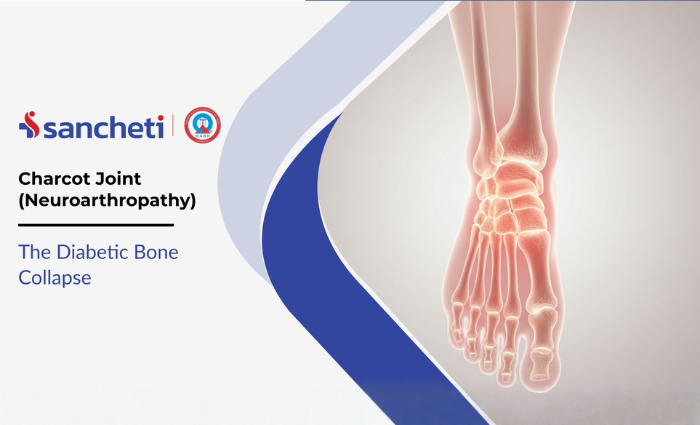 Charcot Joint (Neuroarthropathy): The Diabetic Bone Collapse 9 Charcot Joint (Neuroarthropathy) The Diabetic Bone Collapse