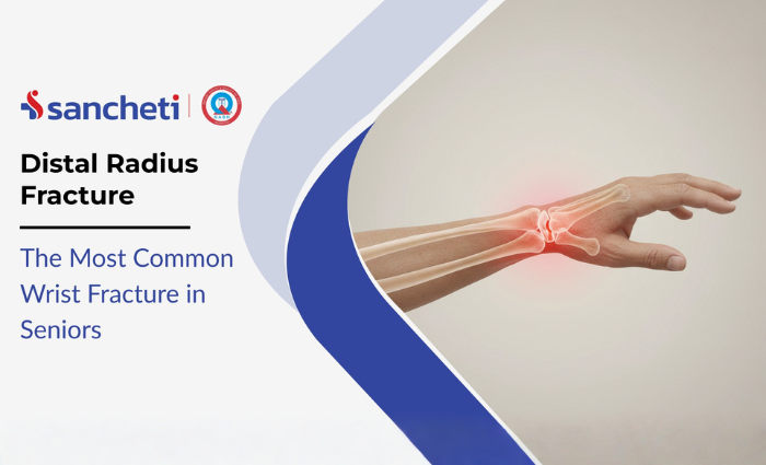 Distal Radius Fracture: The Most Common Wrist Fracture in Seniors 3 Distal Radius Fracture The Most Common Wrist Fracture in Seniors