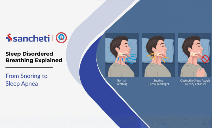Sleep Disordered Breathing Explained: From Snoring to Sleep Apnea 4 Sleep Disordered Breathing Explained From Snoring to Sleep Apnea