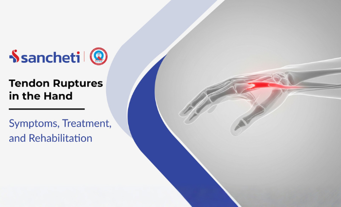 Tendon Ruptures in the Hand: Symptoms, Treatment, and Rehabilitation 7 Tendon Ruptures in the Hand Symptoms, Treatment, and Rehabilitation