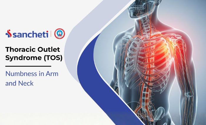 Thoracic Outlet Syndrome (TOS): Numbness in Arm and Neck 10 Thoracic Outlet Syndrome (TOS) Numbness in Arm and Neck