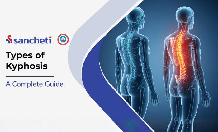 Types of Kyphosis: A Complete Guide 5 types of Kyphosis