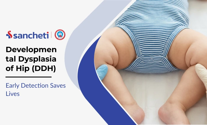 Developmental Dysplasia of Hip (DDH): Early Detection Saves Lives 5 Developmental Dysplasia of Hip (DDH)_ Early Detection Saves Lives