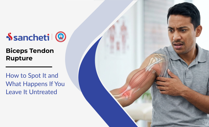 Biceps Tendon Rupture: How to Spot It and What Happens If You Leave It Untreated 6 Biceps Tendon Rupture