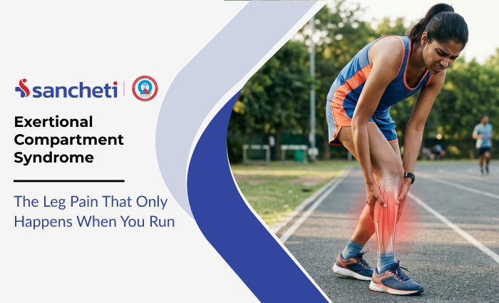 Exertional Compartment Syndrome: The Leg Pain That Only Happens When You Run 8 Exertional Compartment Syndrome
