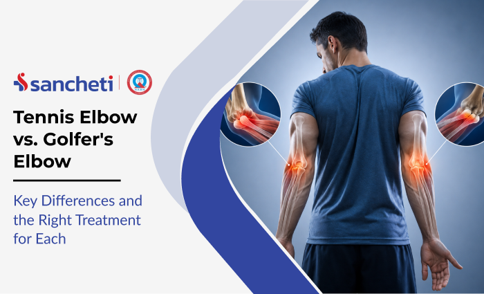 Tennis Elbow vs. Golfer's Elbow: Key Differences and the Right Treatment for Each 1 tennis_elbow_vs_golfer_s_elbow_key_differences_and_the_right_treatment_for_each